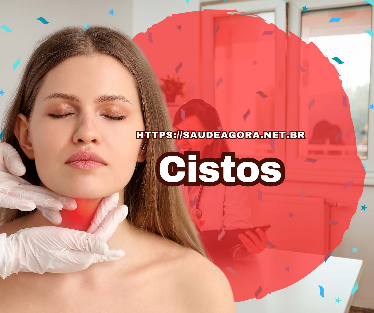 Cistos